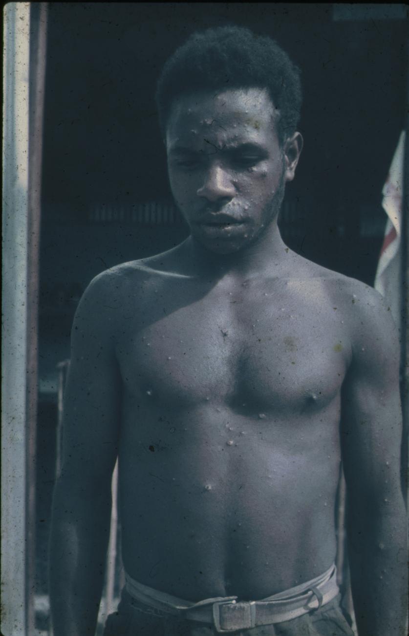 BD/144/487 - 
Jonge man met huidziekte
