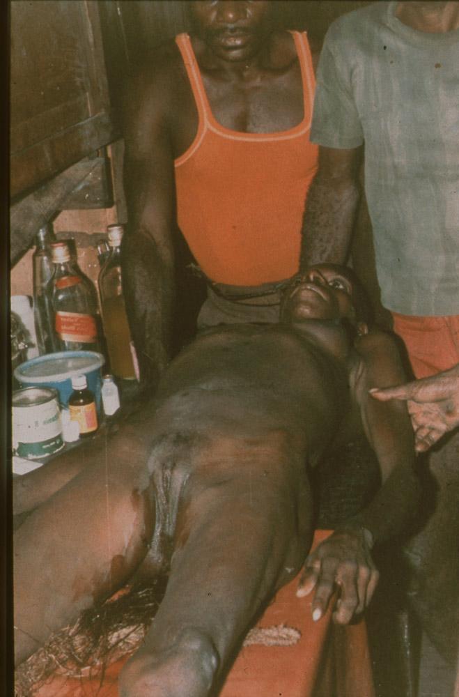 BD/30/80 - 
Asmat woman lying on a treatment table with Asmat men standing next to her
