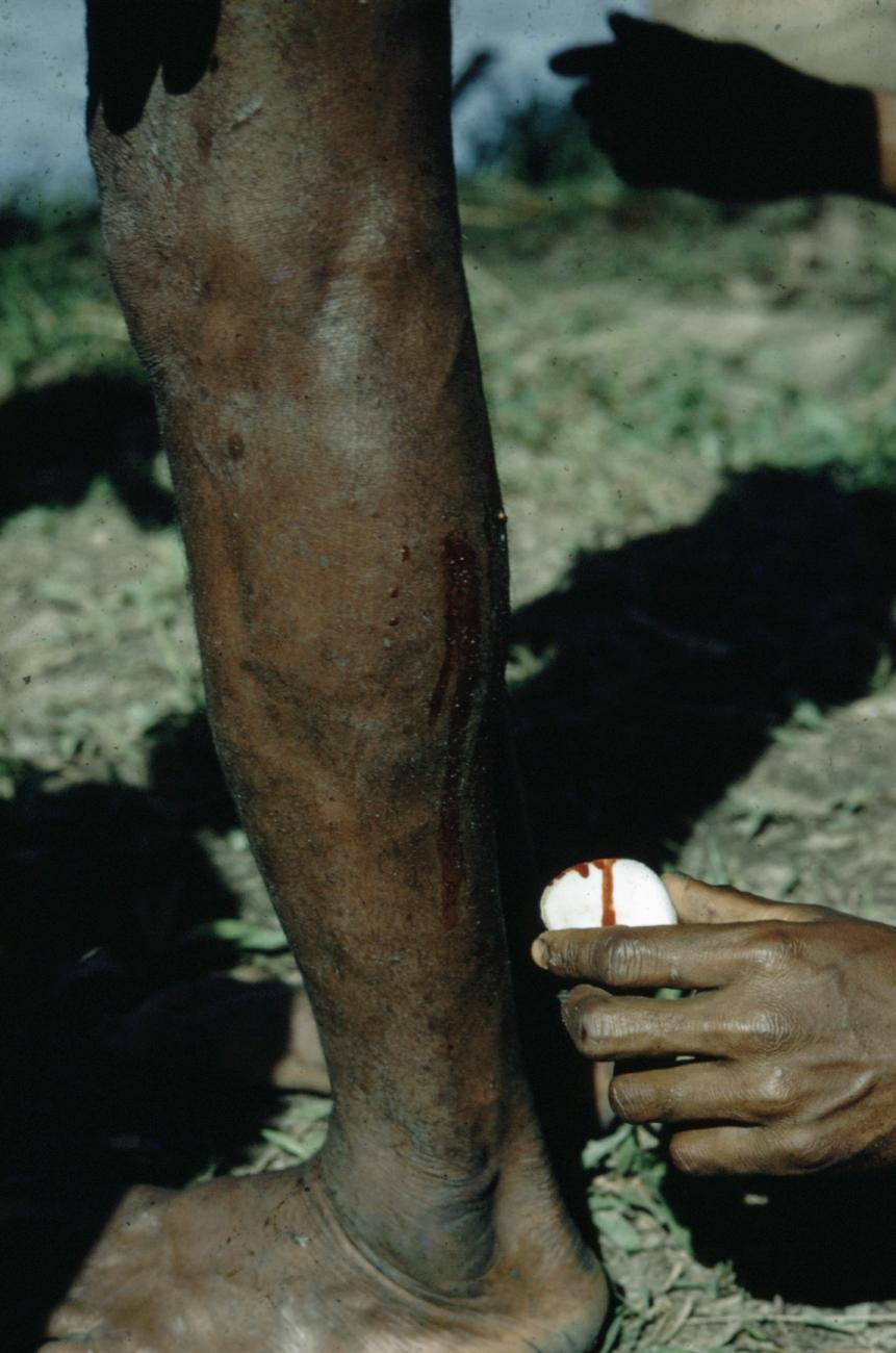 BD/66/139 - 
Bloed wordt afgenomen van een been om een trommel te plakken
